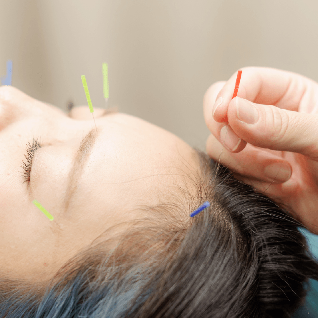 niwatocoの美容鍼